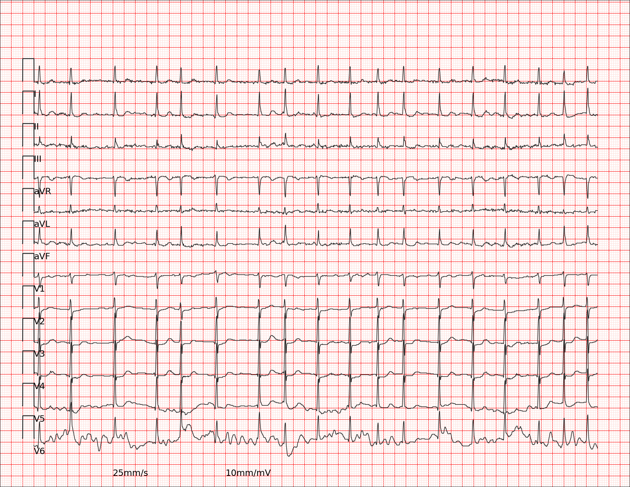 Example ECG Input